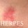 obat penyakit herpes tradisional
